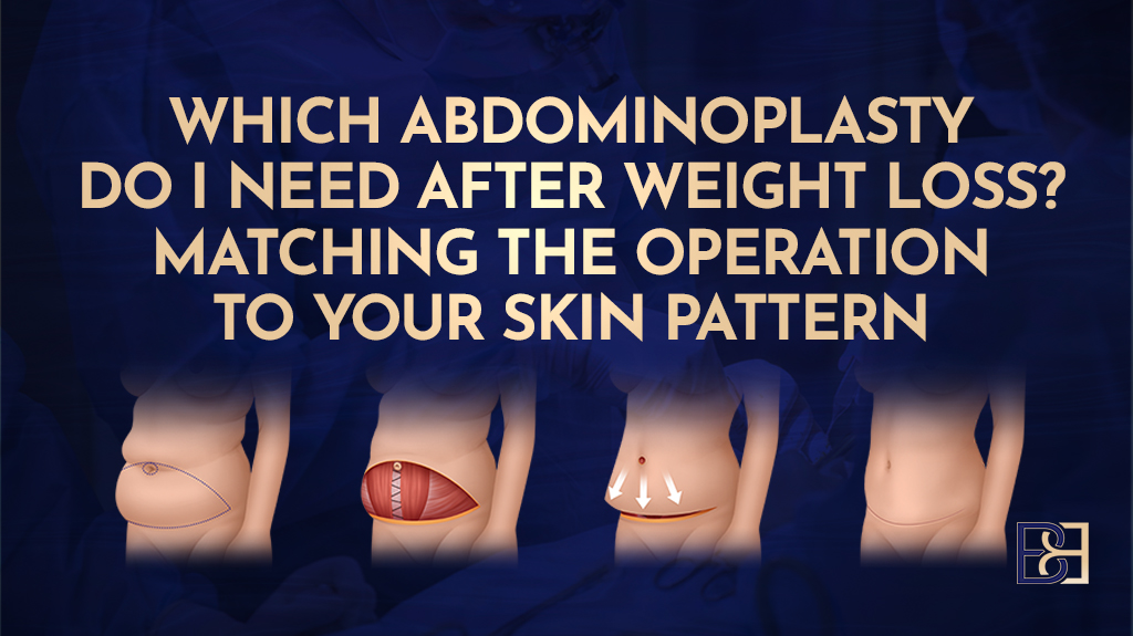 Which Abdominoplasty (Tummy Tuck) Do I Need After Weight Loss? Matching the Operation to Your Skin Pattern