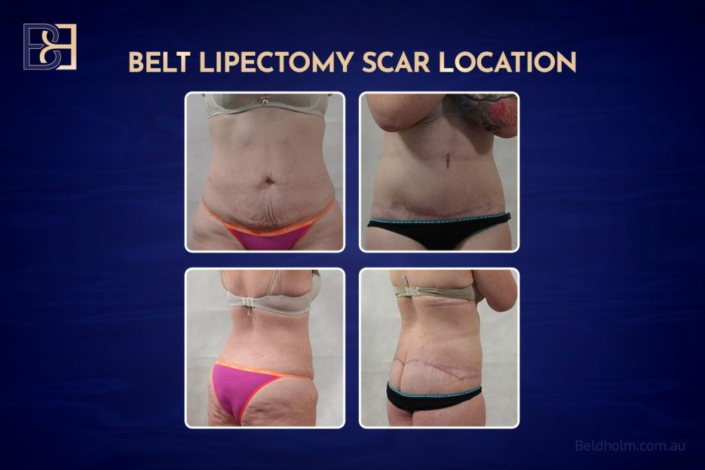 Belt Lipectomy Scar Location