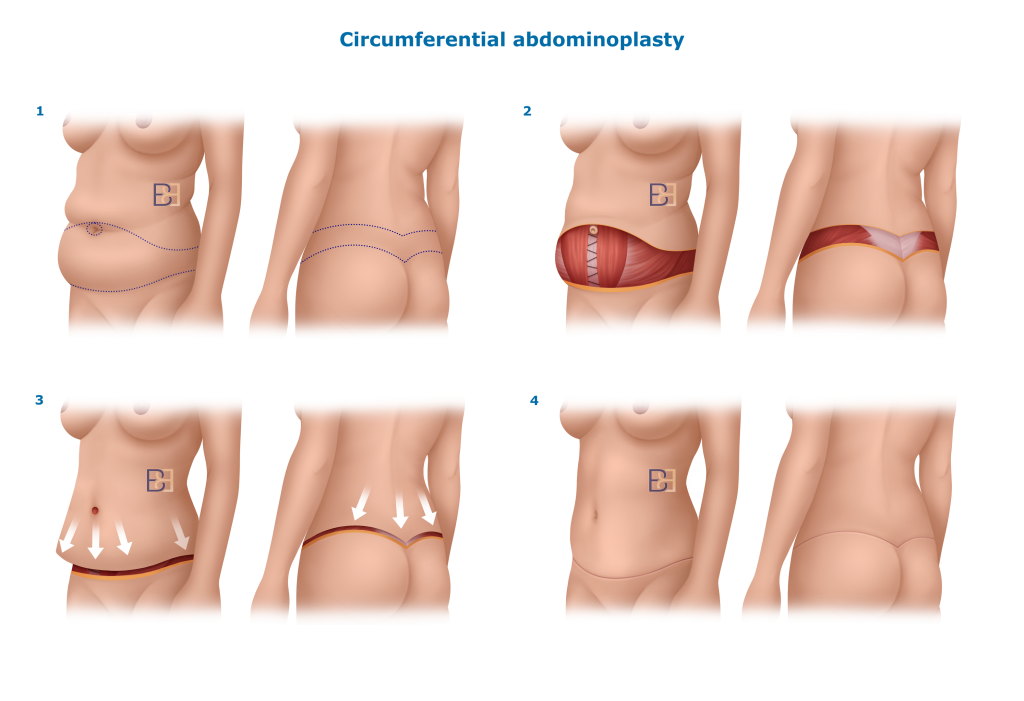 Body Lift (Belt Lipectomy) Scars After Weight Loss: Managing and Caring for Your Scar 1 Body Lift (Belt Lipectomy) Scars After Weight Loss: Managing and Caring for Your Scar - Circumferential Abdominoplasty