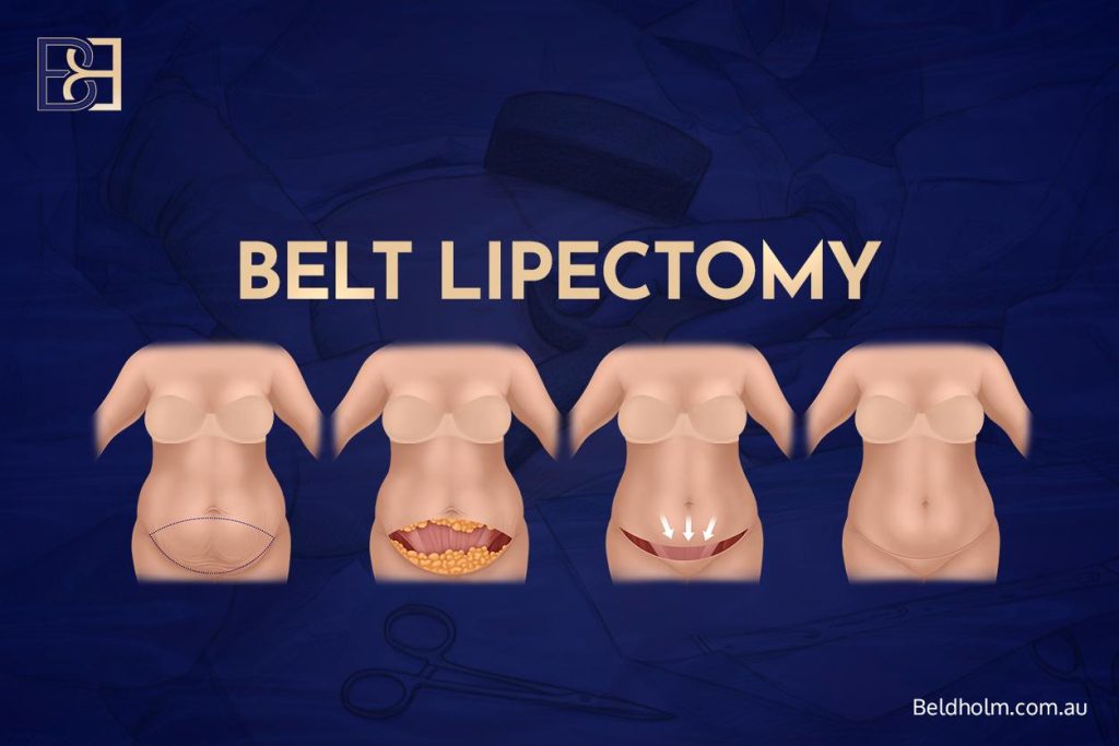 Abdominoplasty (Tummy Tuck) After Weight Loss: A Complete Guide for Post Weight Loss Patients 14 Body lift (belt lipectomy)