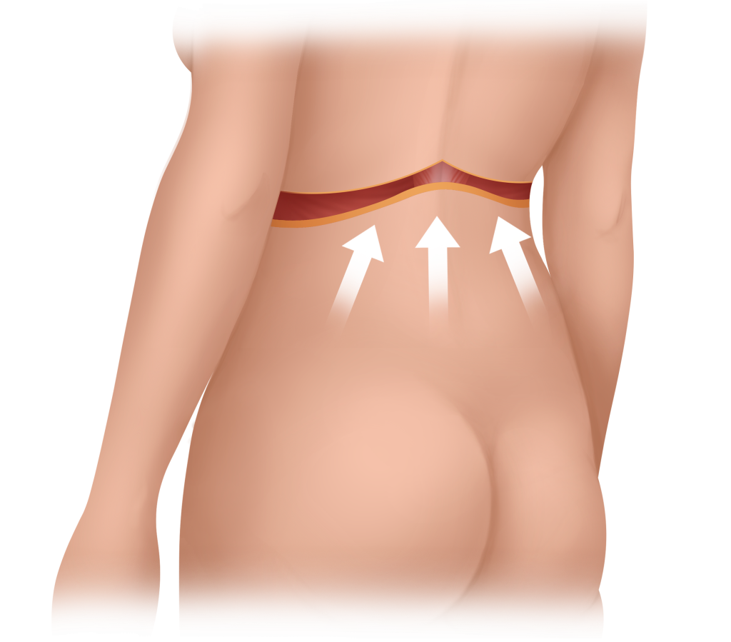 Bra line lipectomy (upper back lipectomy)
