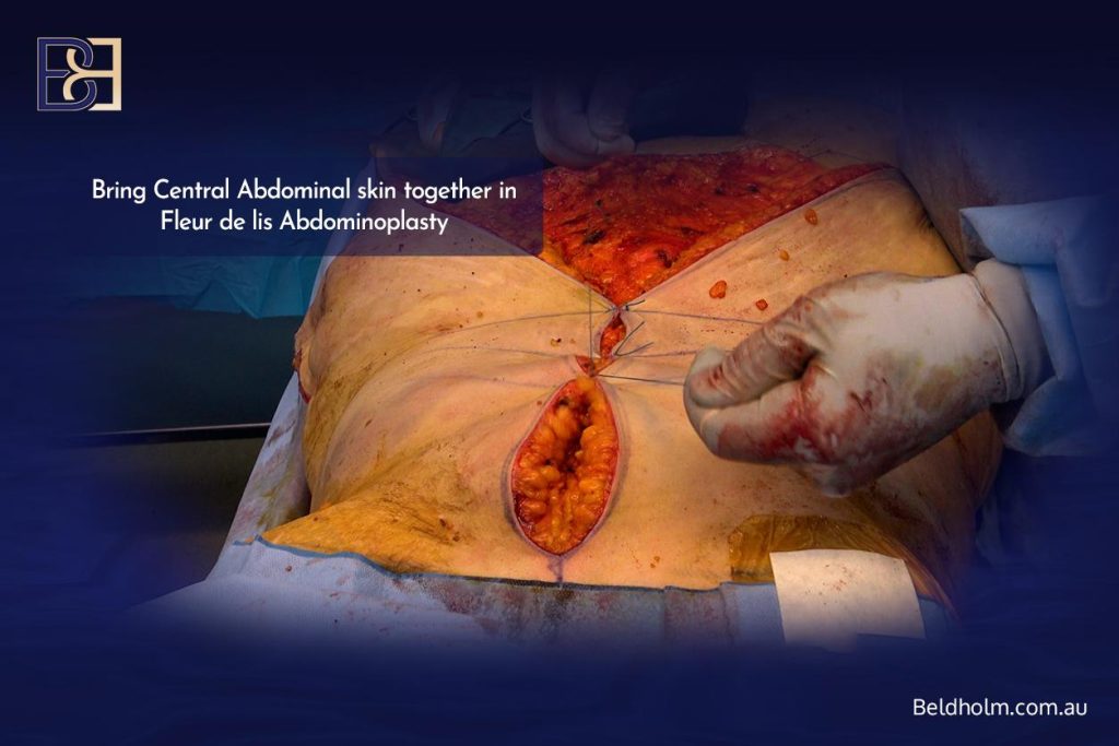 Closing the vertical incision