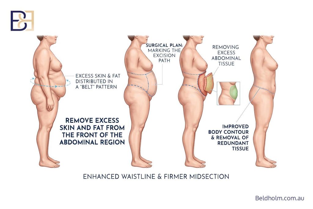 Choosing Between a Belt Lipectomy (Body Lift) and Abdominoplasty (Tummy Tuck) After Weight Loss 10 Enhance waistline