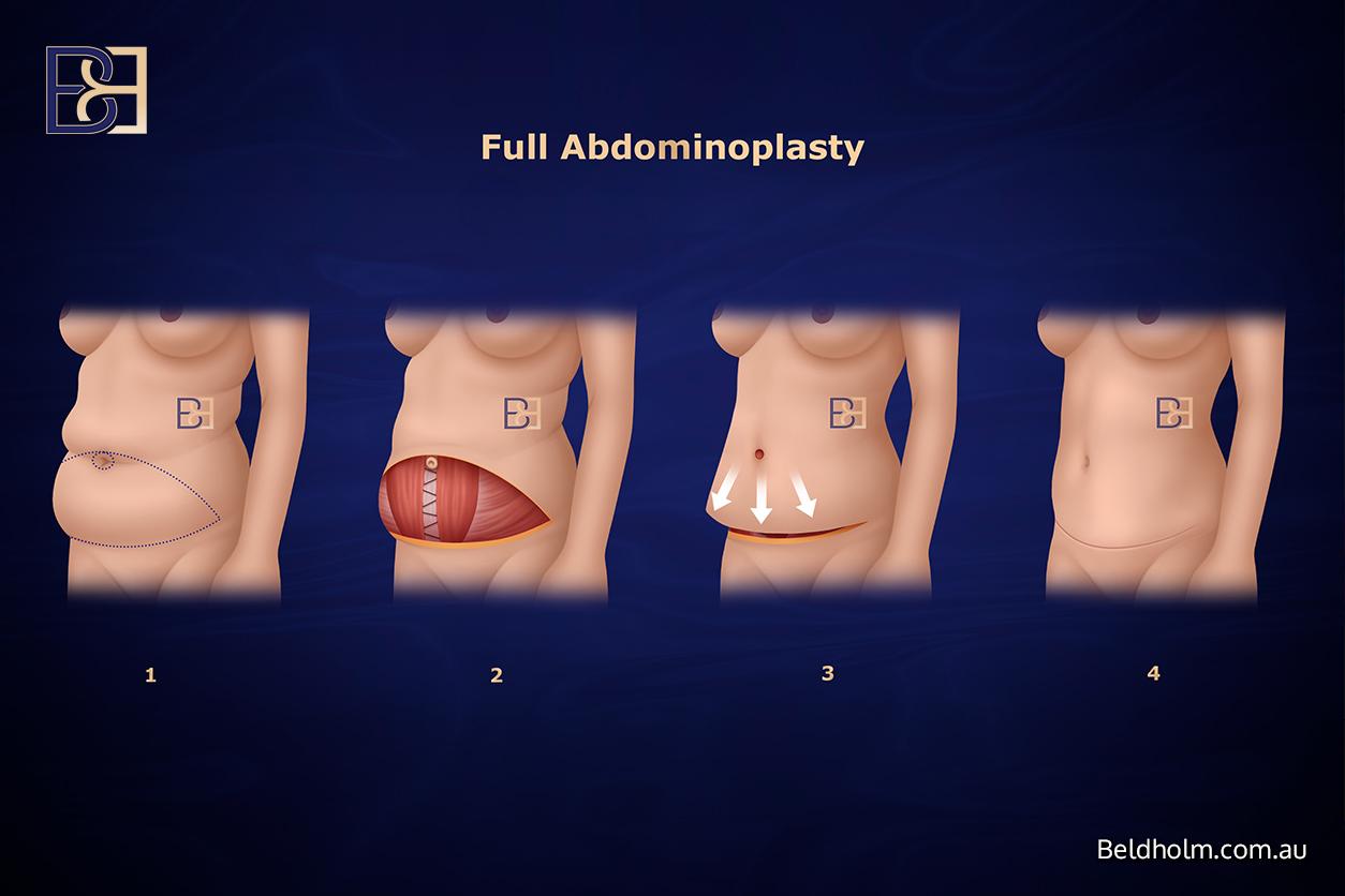 Abdominoplasty (Tummy Tuck) Cost After Pregnancy in Newcastle NSW 1 Full abdominoplasty (tummy tuck)