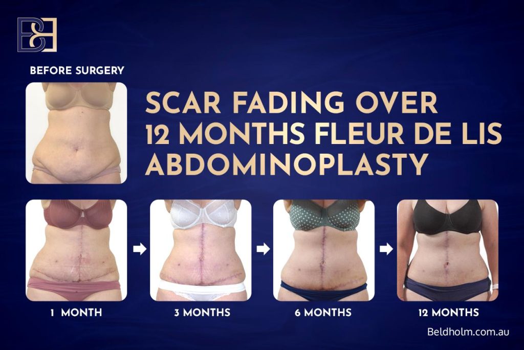 How abdominoplasty (tummy tuck) scars heal over time