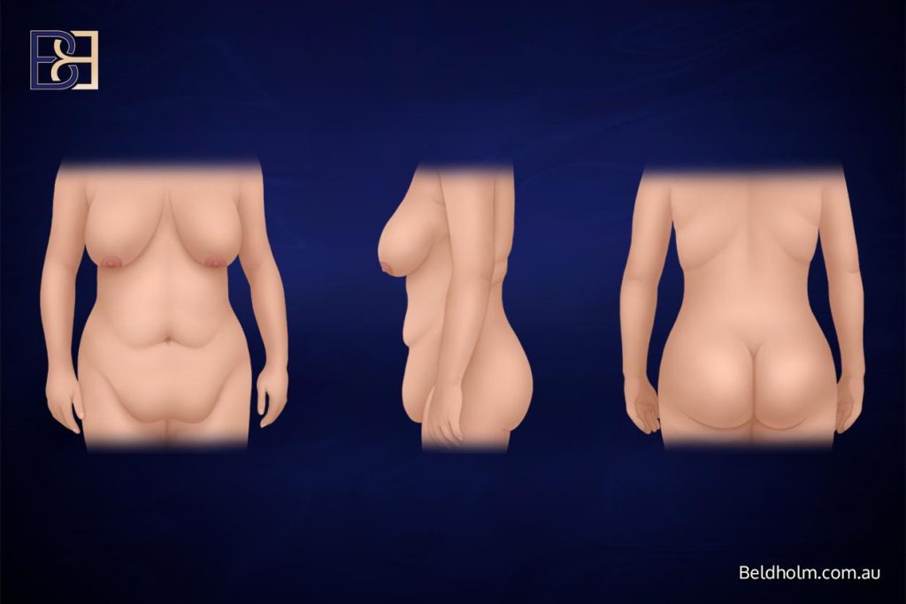 How weight gain and weight loss change the umbilicus