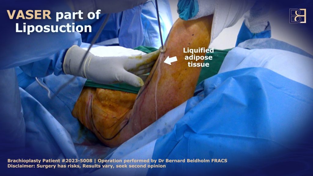 Liposuction (suction assisted lipectomy) is usually part of it