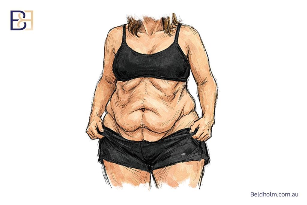 Abdominoplasty (Tummy Tuck) After Weight Loss: A Complete Guide for Post Weight Loss Patients 3 Loose overhanging skin