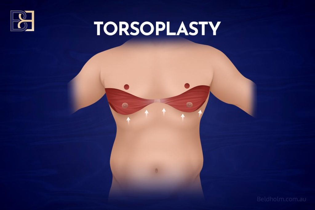 Male chest surgery (upper body lift, torsoplasty)