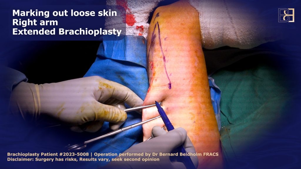 Marking out Loose Skin
