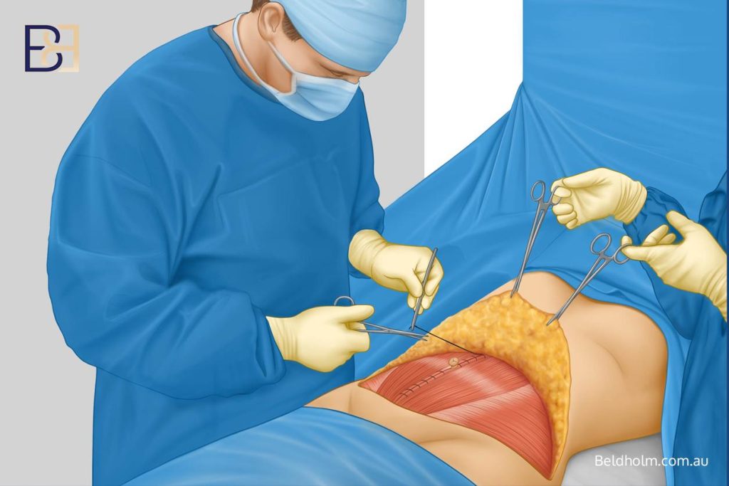 Abdominoplasty (Tummy Tuck) After Weight Loss: A Complete Guide for Post Weight Loss Patients 30 Muscle repair if needed