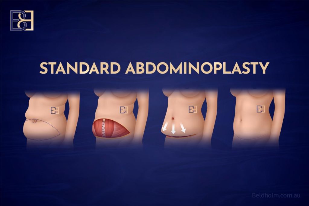 Preparing for Abdominoplasty (Tummy Tuck) After Weight Loss: My Top Tips