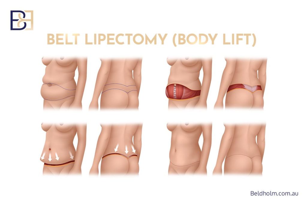 Preparing for Your Belt Lipectomy (Body Lift) Consultation After Weight Loss