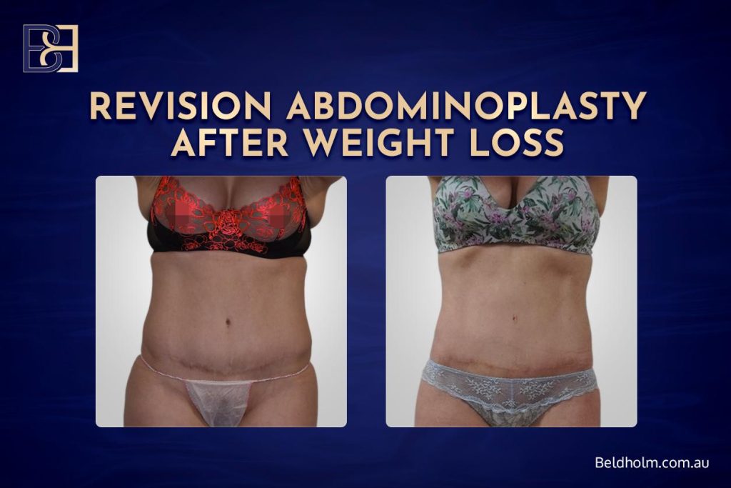 Revision Abdominoplasty After Weight Loss