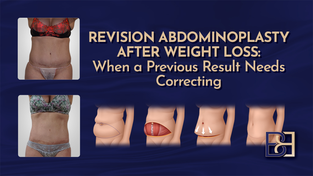 Revision Abdominoplasty After Weight Loss: When a Previous Result Needs Correcting