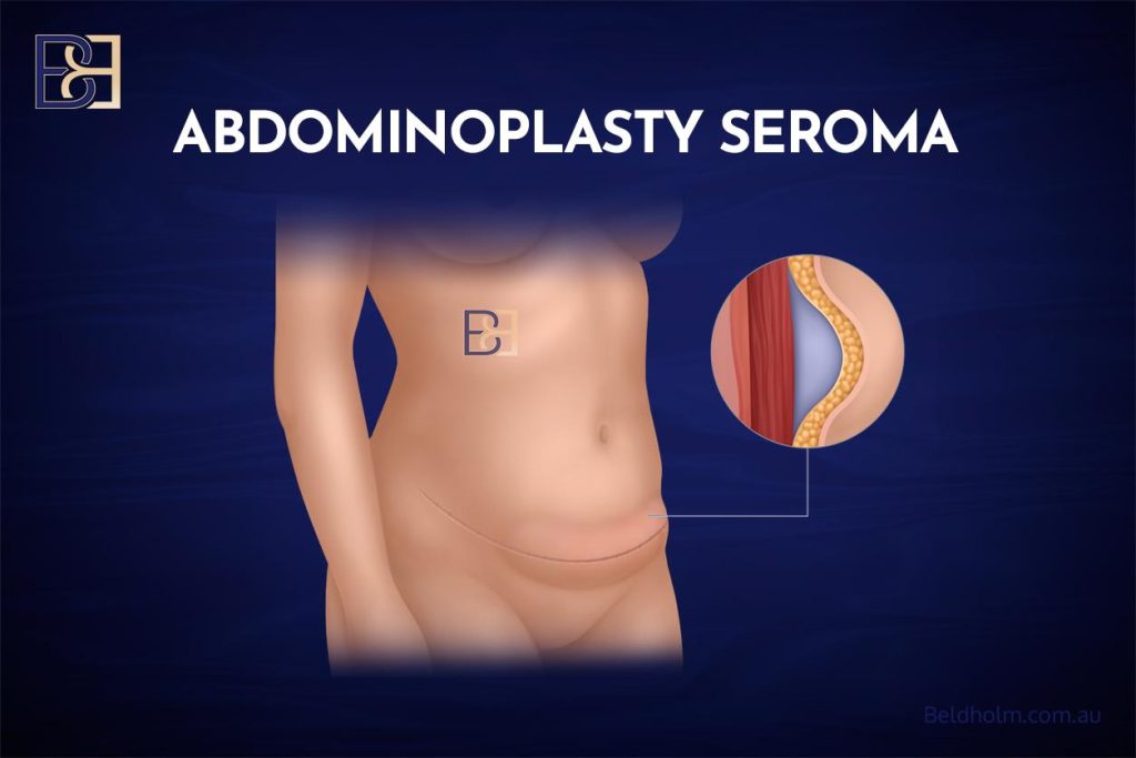 Seroma and pseudobursa