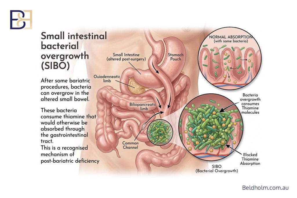 Small intestinal bacterial overgrowth