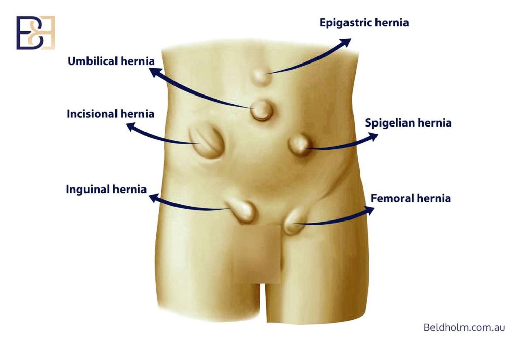 Symptomatic Versus Asymptomatic Hernias