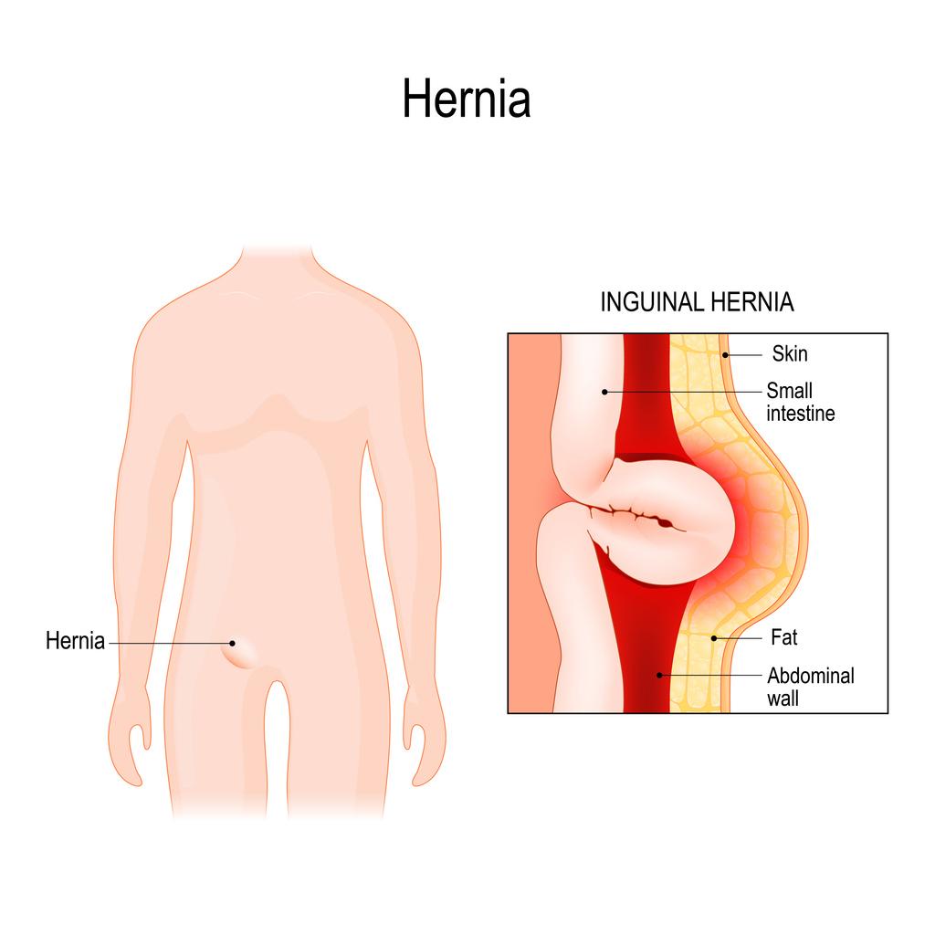 Symptomatic hernias