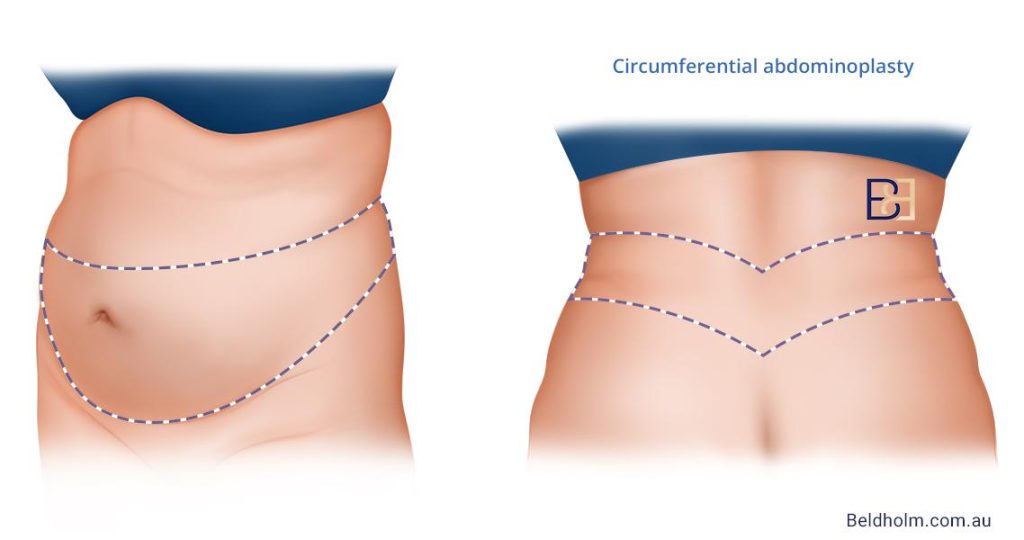 Body Lift (Belt Lipectomy) Scars After Weight Loss: Managing and Caring for Your Scar 2 The incision runs around the waist