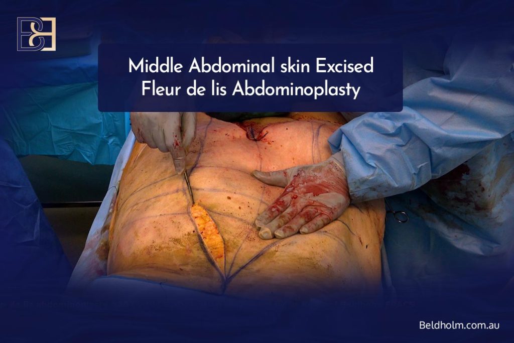 The vertical incision and central skin removal