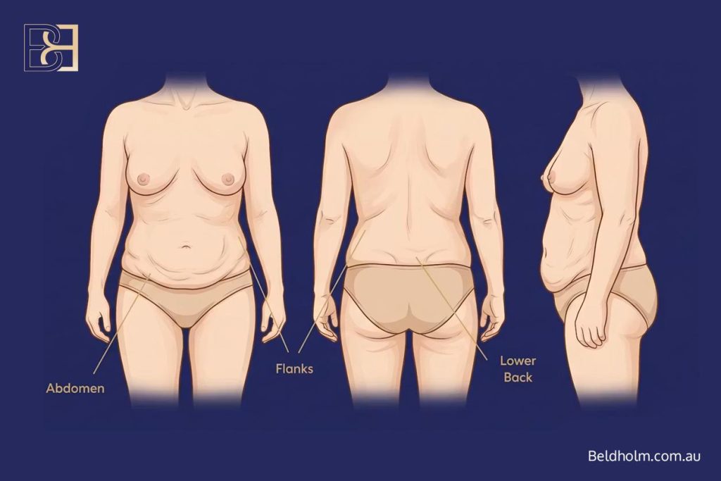 Why loose skin develops on the abdomen and back after weight loss