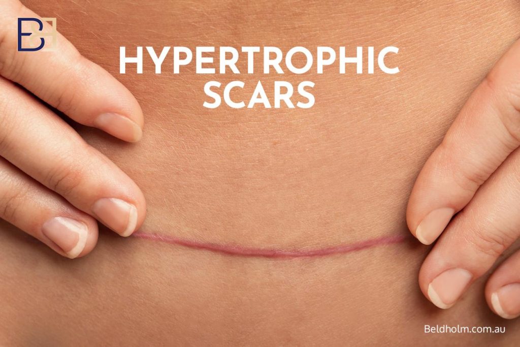Why scars tend to be longer after weight loss