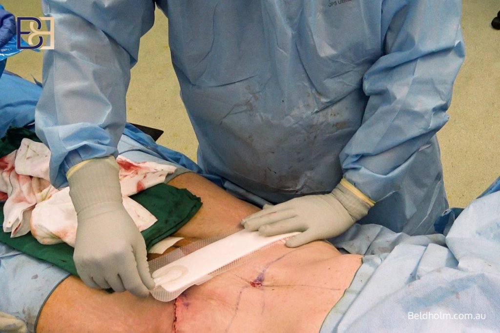 How Ultrasound-Assisted Suction Lipectomy (VASER Liposuction) Is Used in Post Pregnancy Abdominoplasty (Tummy Tuck) 20 Abdominoplasty Operation Steps - Dressings and garment