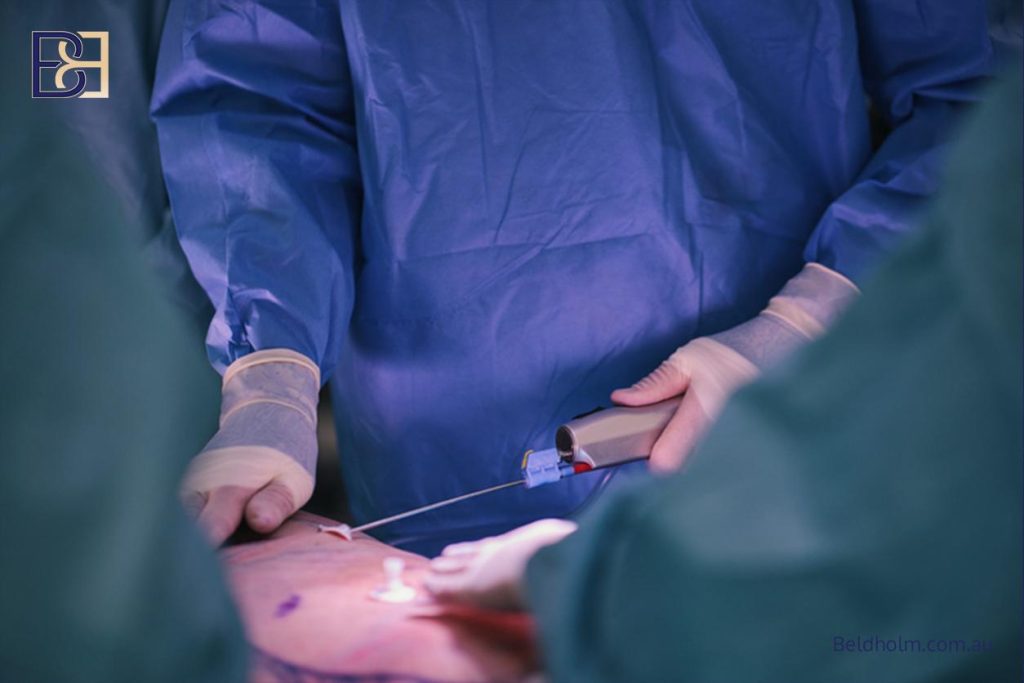 How Ultrasound-Assisted Suction Lipectomy (VASER Liposuction) Is Used in Post Pregnancy Abdominoplasty (Tummy Tuck) 17 Abdominoplasty Operation Steps - Liposuction first