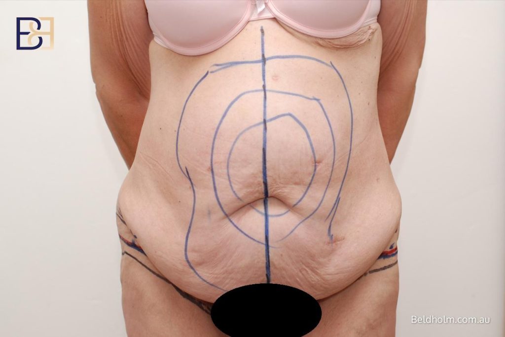 How Ultrasound-Assisted Suction Lipectomy (VASER Liposuction) Is Used in Post Pregnancy Abdominoplasty (Tummy Tuck) 15 Abdominoplasty Operation Steps - Markings