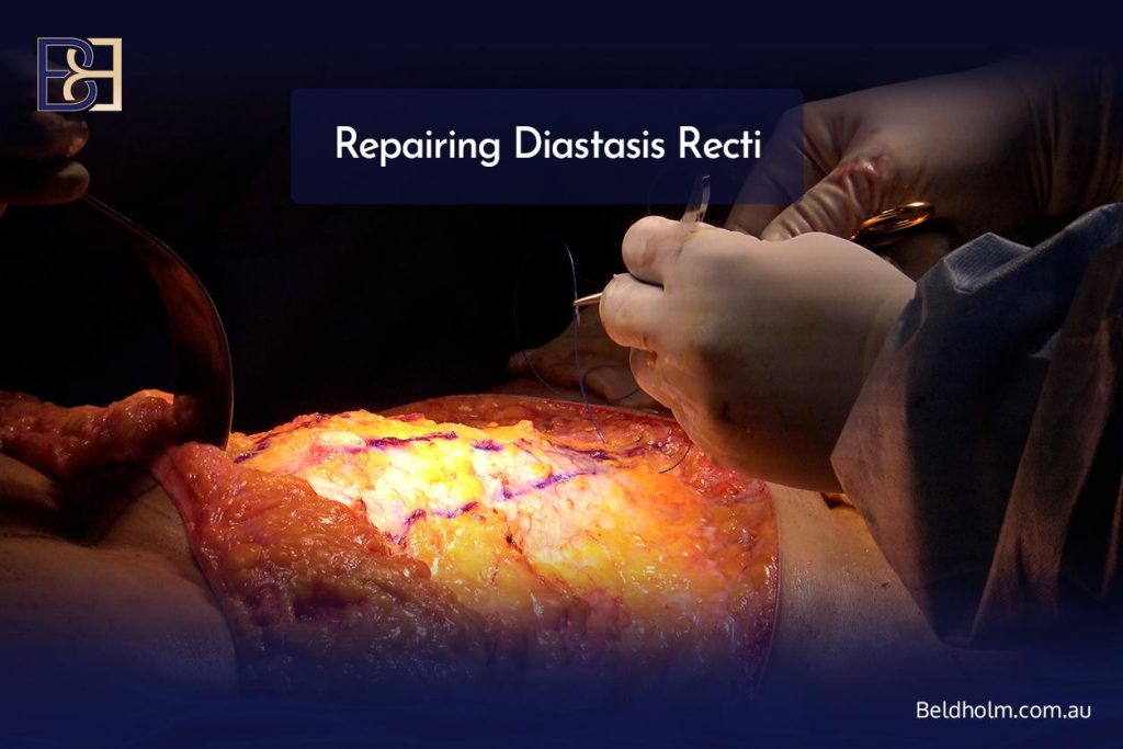 How Ultrasound-Assisted Suction Lipectomy (VASER Liposuction) Is Used in Post Pregnancy Abdominoplasty (Tummy Tuck) 18 Abdominoplasty Operation Steps - Skin removal and muscle repair