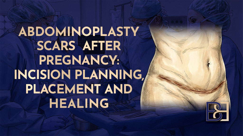 Abdominoplasty Scars After Pregnancy Incision Planning Placement and Healing-featured image
