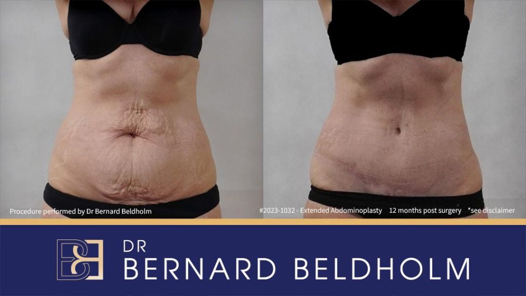 Abdominoplasty leaves a permanent scar 2023 - 1032