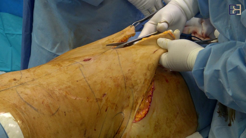 An abdominoplasty (tummy tuck) is a planned operation on the abdominal wall 