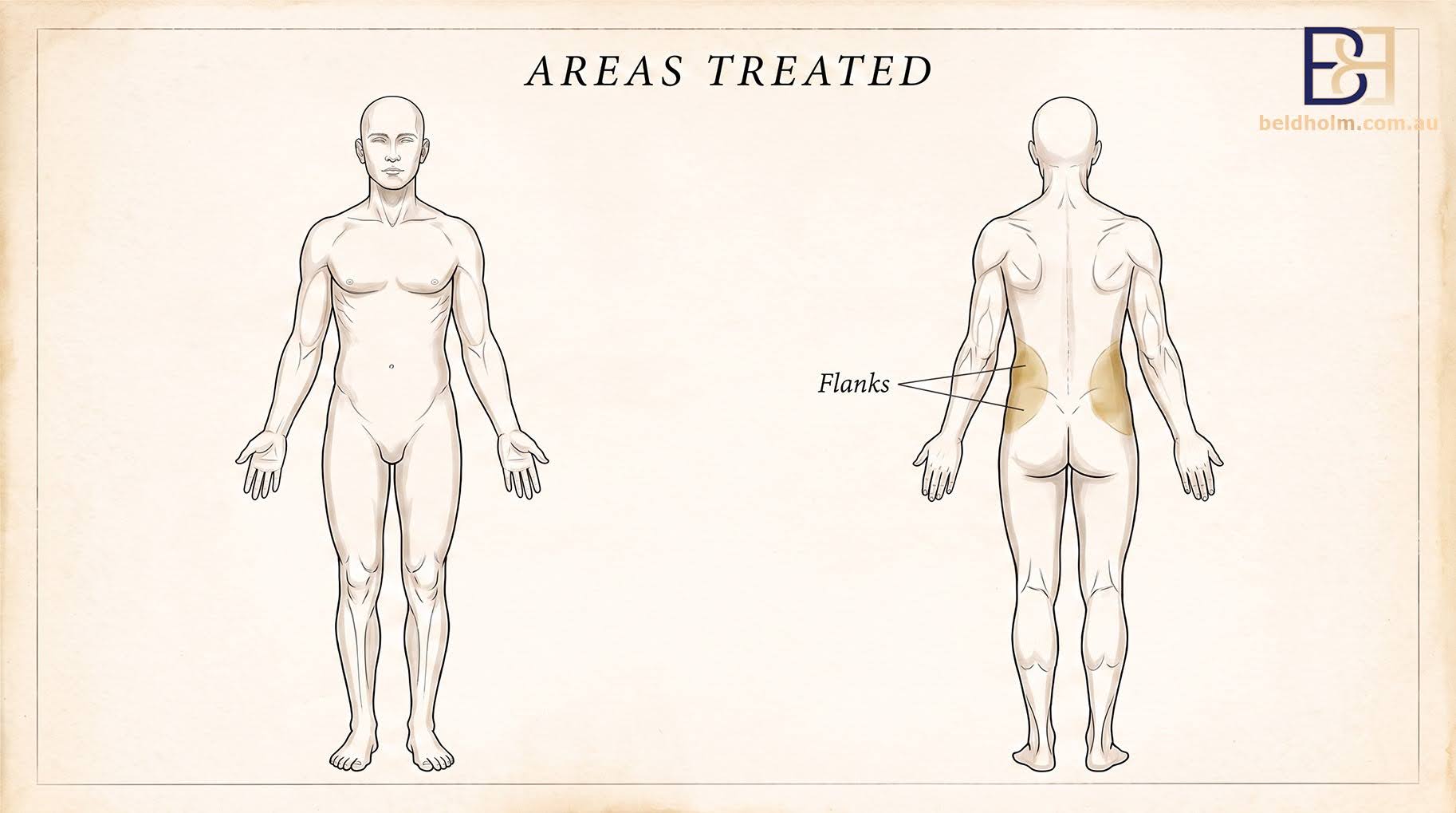 Areas Treated - Sides - VASER Liposuction (Ultrasound Assisted Lipectomy) of the Abdomen