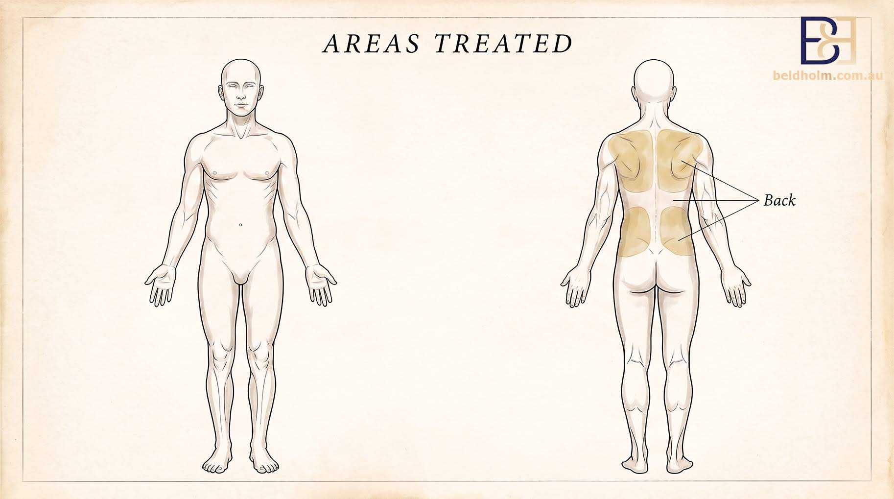 Areas Treated - VASER Liposuction (Ultrasound Assisted Lipectomy) of the Back