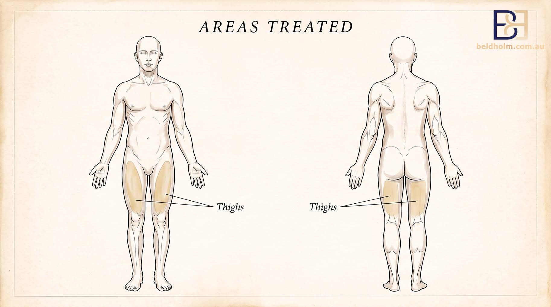 VASER Liposuction (Ultrasound Assisted Lipectomy) of the Thighs