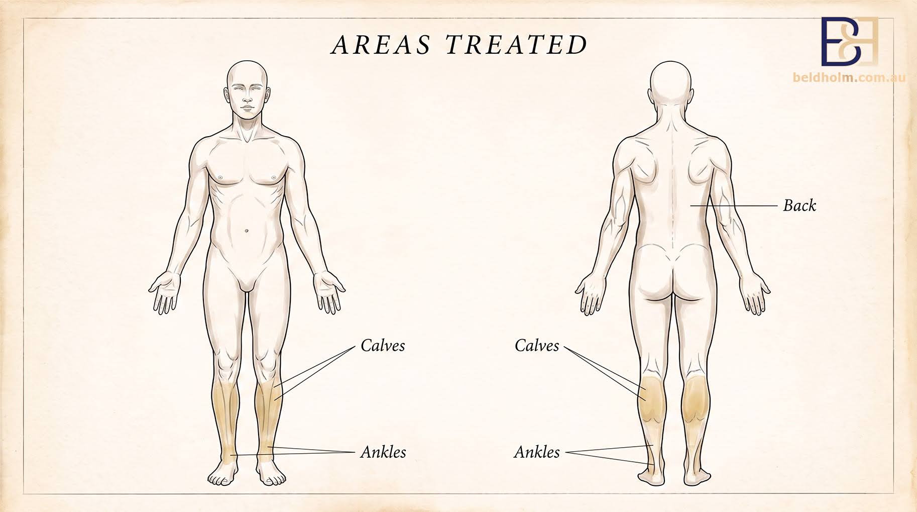 Areas Treated - VASER Liposuction of the Calves & Ankles