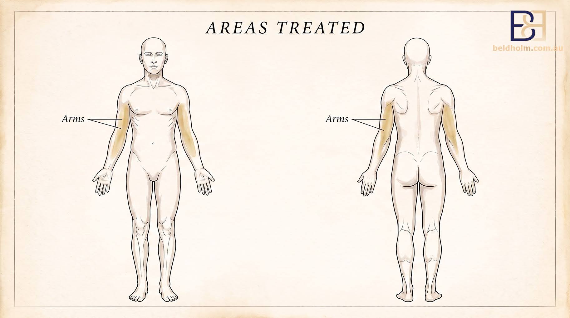 Arm Treated - VASER Liposuction (Ultrasound Assisted Lipectomy) of the Arms
