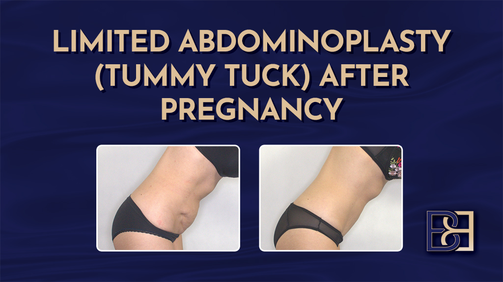 Limited Abdominoplasty (Tummy Tuck) After Pregnancy 3 Limited Abdominoplasty (Tummy Tuck) After Pregnancy