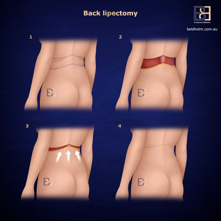 Back Lipectomy