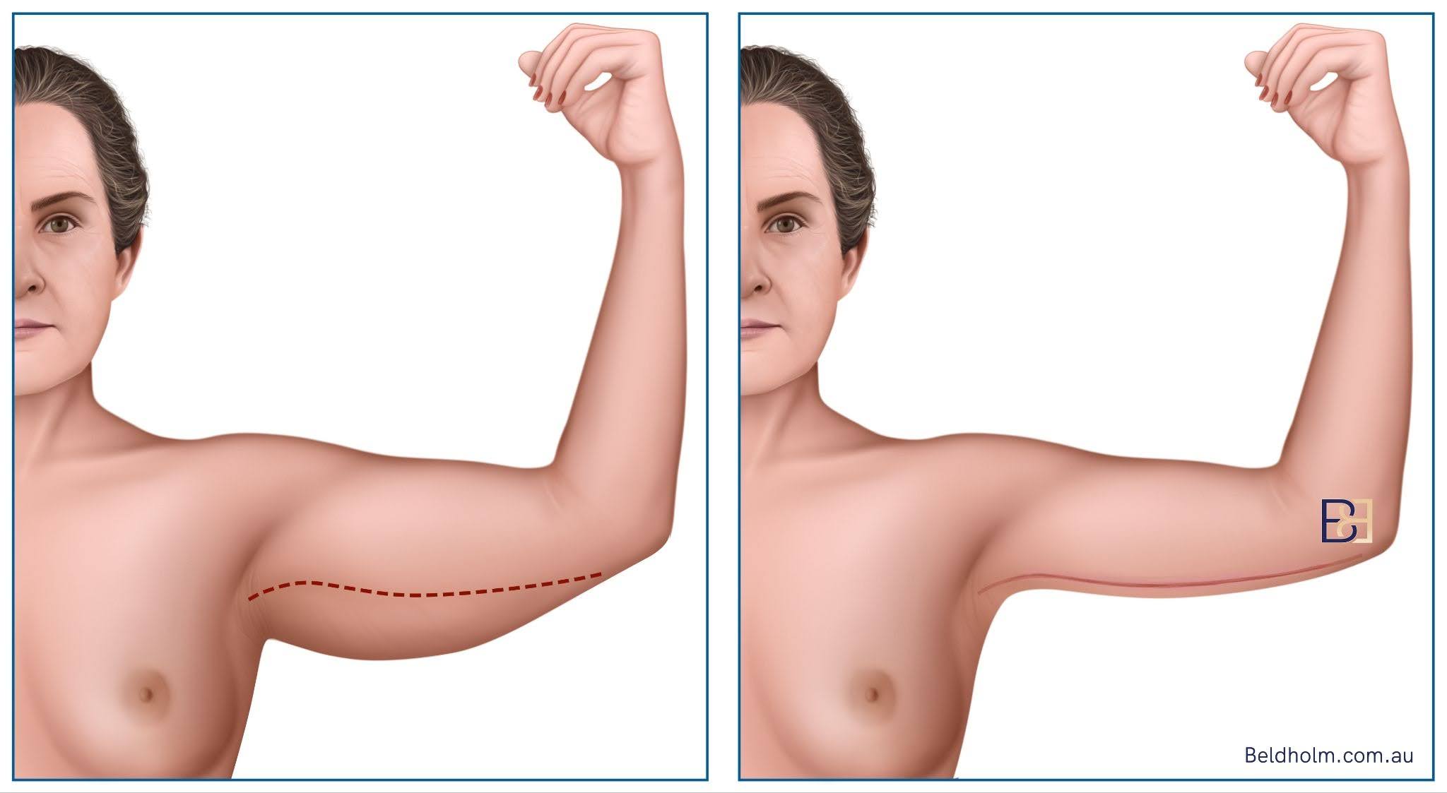 Brachioplasty - VASER Liposuction (Ultrasound Assisted Lipectomy) of the Arms