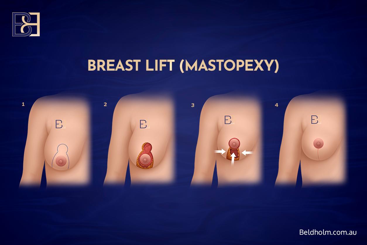 Breast Lift Mastopexy - Dr Bernard Beldholm