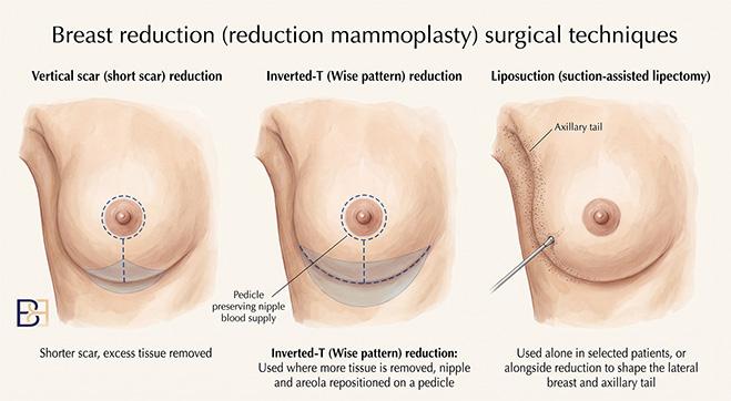 Breast Reduction (Reduction Mammoplasty) in Newcastle NSW 4 Breast Reduction Surgical Technique - Dr Bernard Beldholm