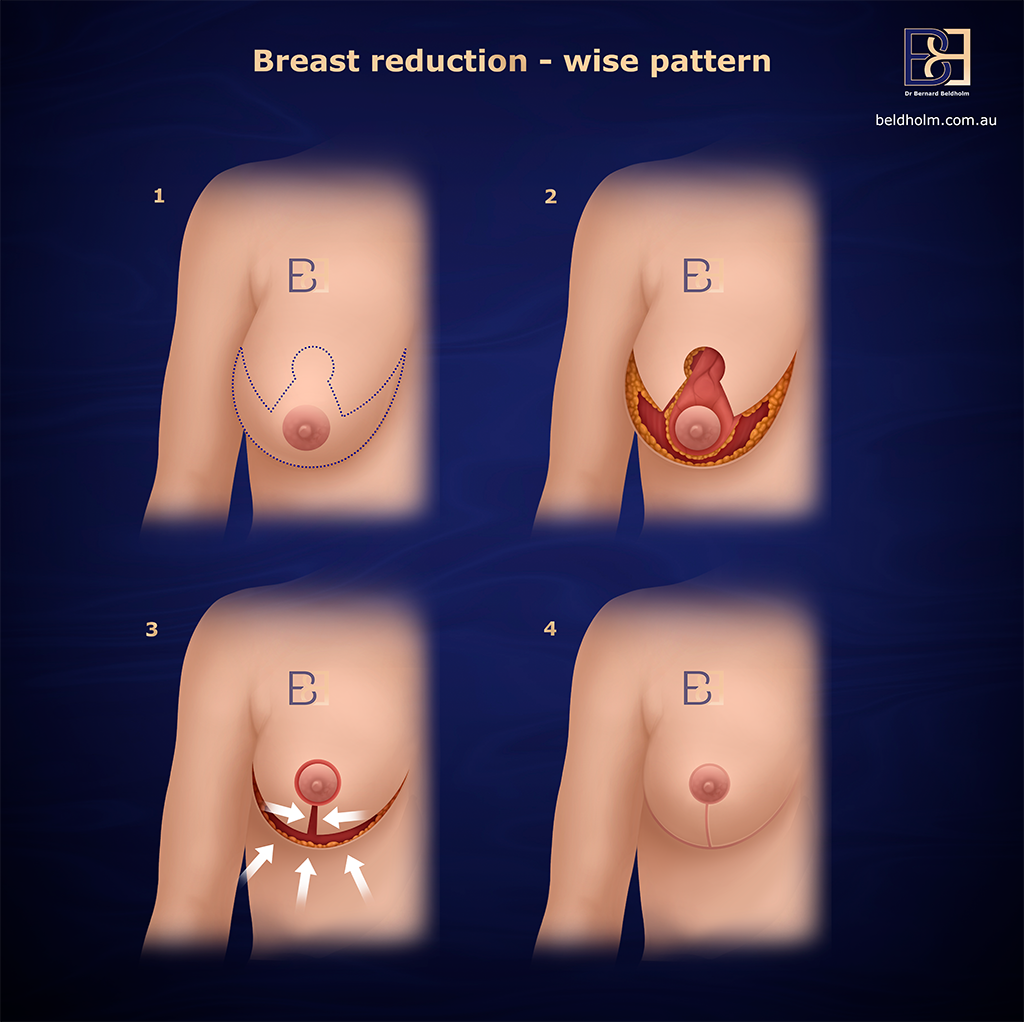 Breast Reduction (Reduction Mammoplasty) in Newcastle NSW 1 Breast Reduction Wise Pattern - Dr Bernard Beldholm
