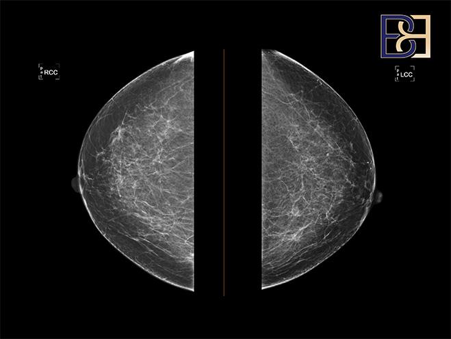 Breast imaging and surveillance - Dr Bernard Beldholm
