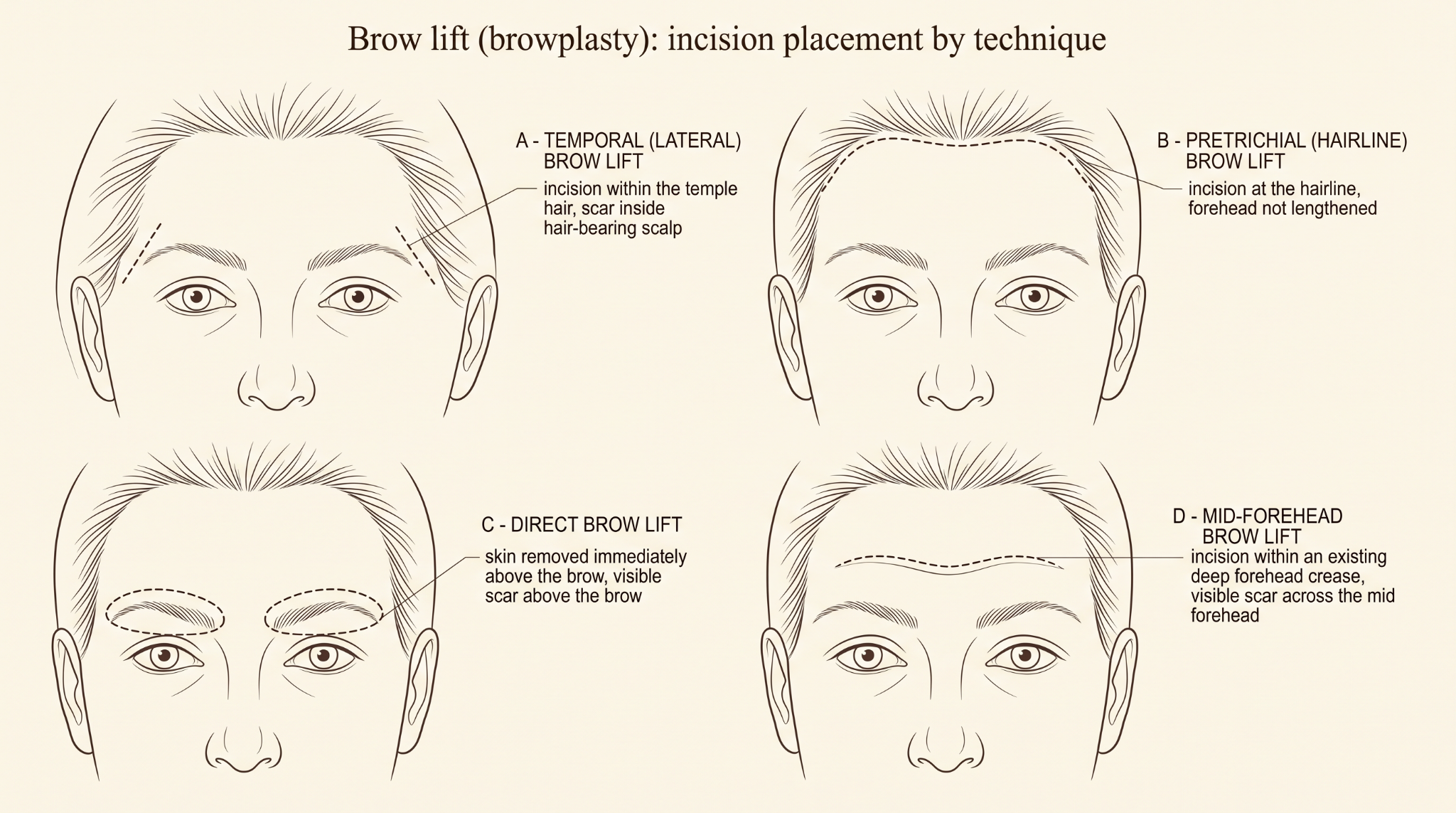 Brow Lift (Browplasty)