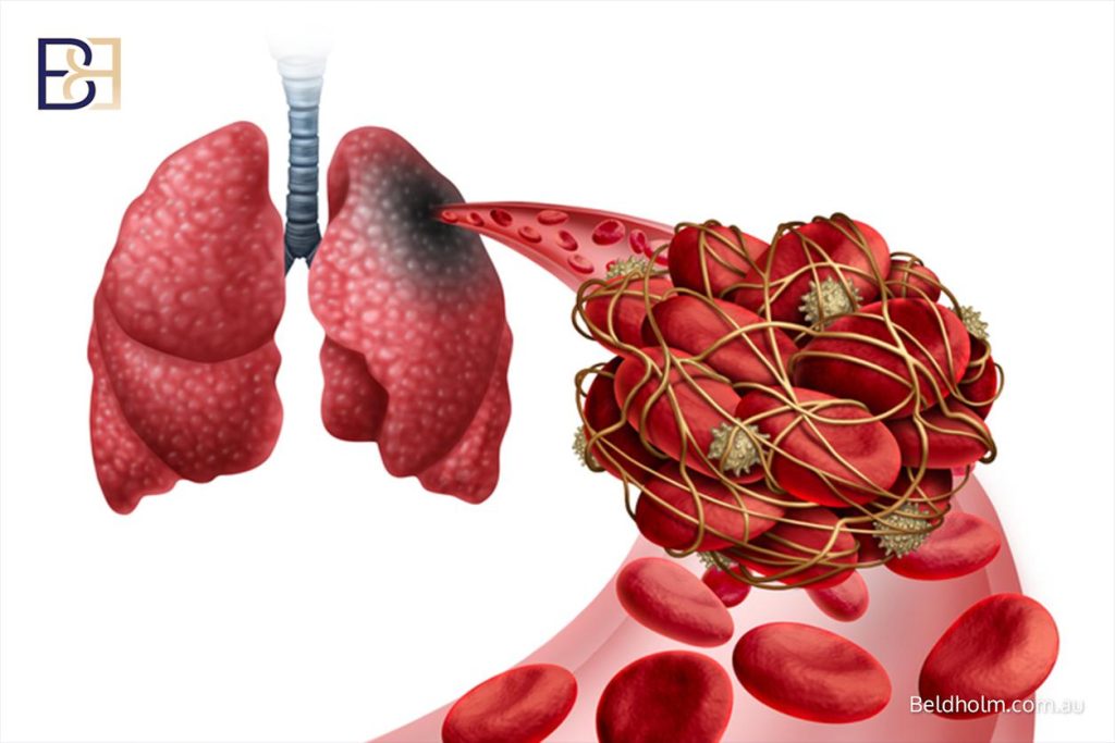 Clot prevention