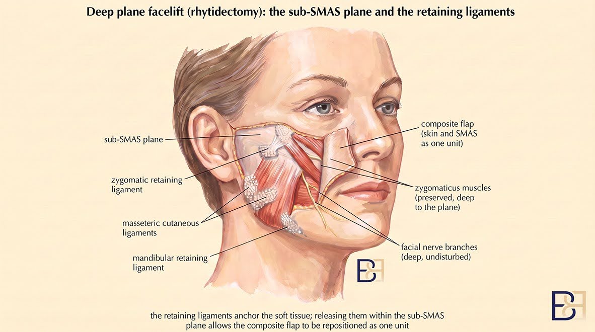 Deep plane Facelift (Rhytidectomy)