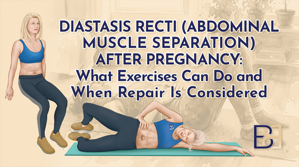 Diastasis Recti After Pregnancy What Exercises Can Do and When Repair Is Considered-featured image